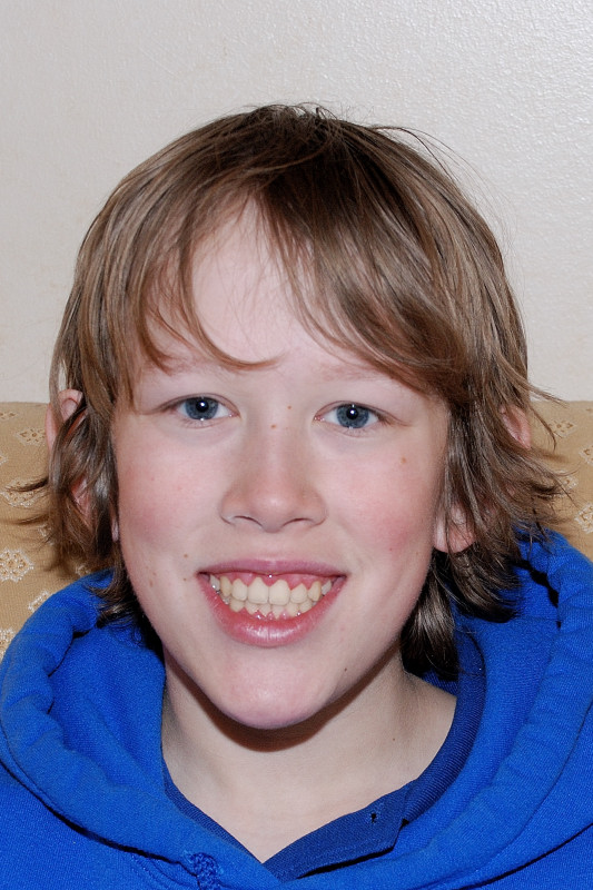 His first picture without braces