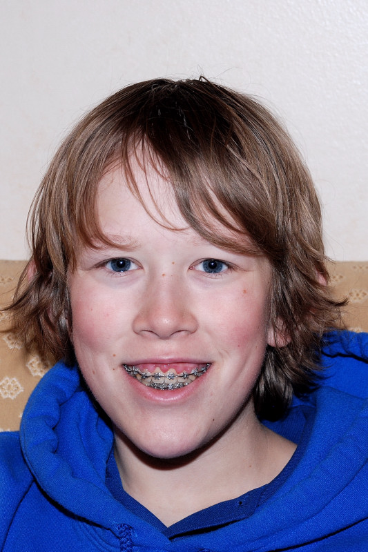 The last picture with braces!